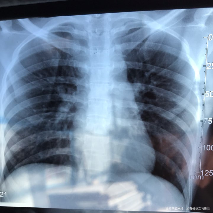 麻烦各位教授给我看看输卵管造影片子,谢谢了🙏