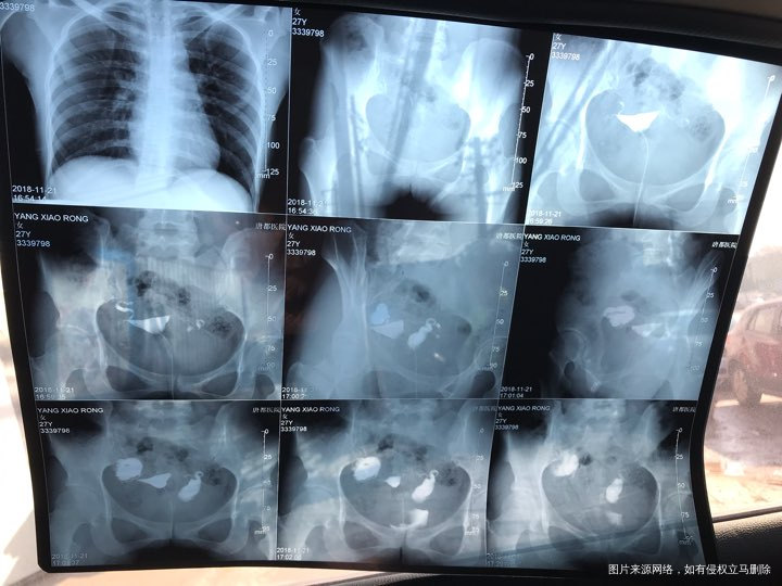 麻烦各位教授给我看看输卵管造影片子,谢谢了🙏