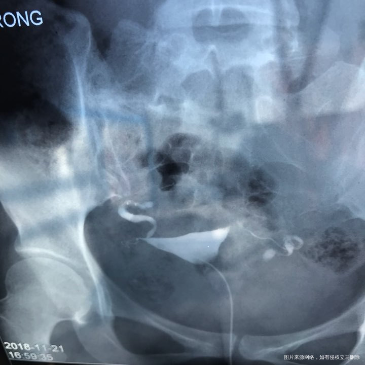 麻烦各位教授给我看看输卵管造影片子,谢谢了🙏