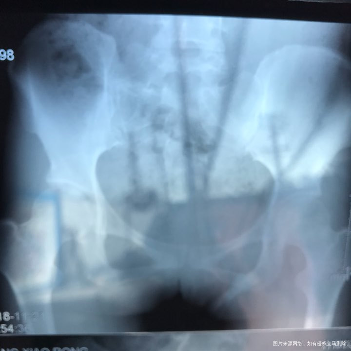 麻烦各位教授给我看看输卵管造影片子,谢谢了🙏