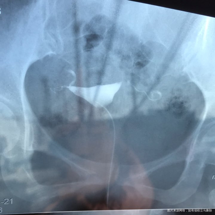 麻烦各位教授给我看看输卵管造影片子,谢谢了🙏