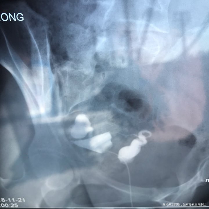 麻烦各位教授给我看看输卵管造影片子,谢谢了🙏