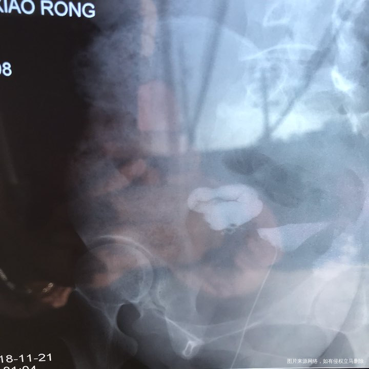 麻烦各位教授给我看看输卵管造影片子,谢谢了🙏