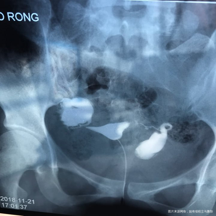 麻烦各位教授给我看看输卵管造影片子,谢谢了🙏