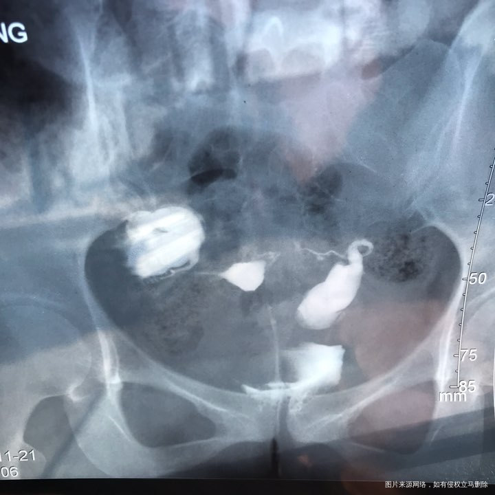 麻烦各位教授给我看看输卵管造影片子,谢谢了🙏