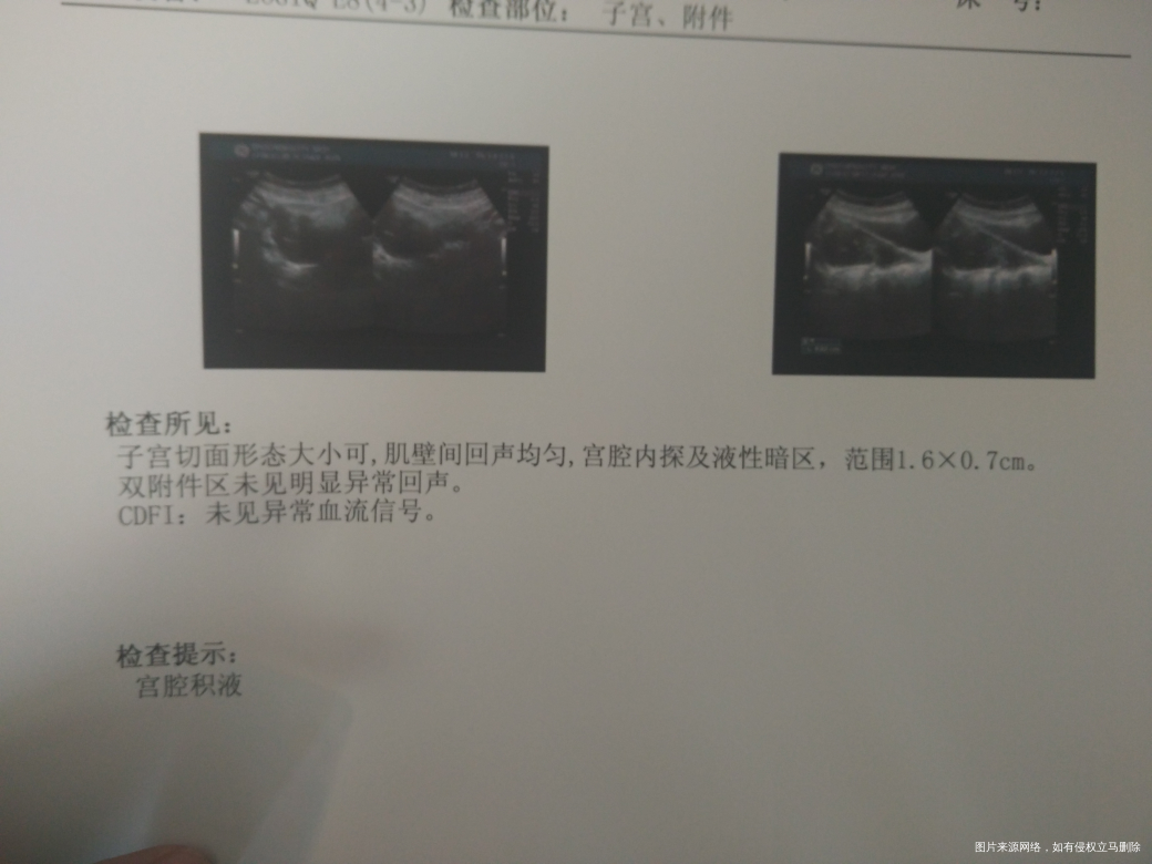 求助医生看看,流产第14天,显示有宫腔积液1.6*0.7cm?