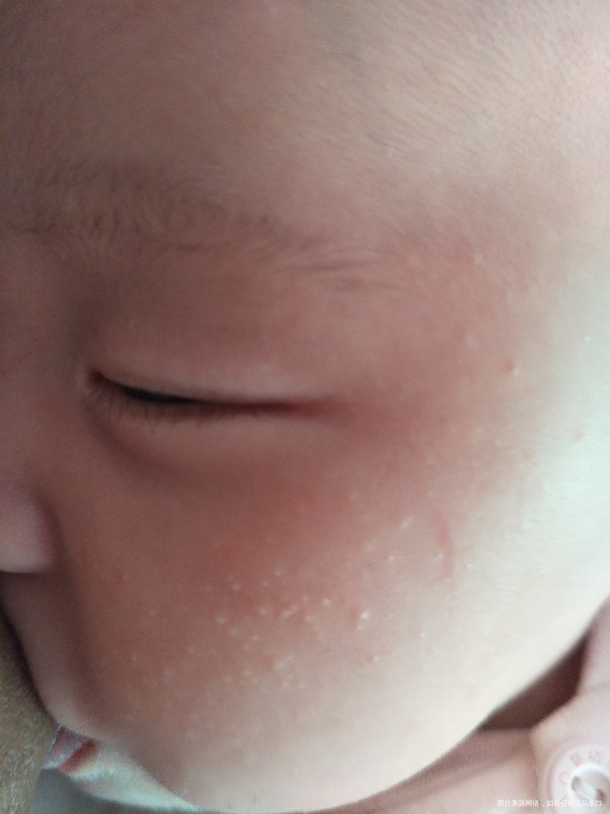 宝宝这两天脸上起好多痘痘