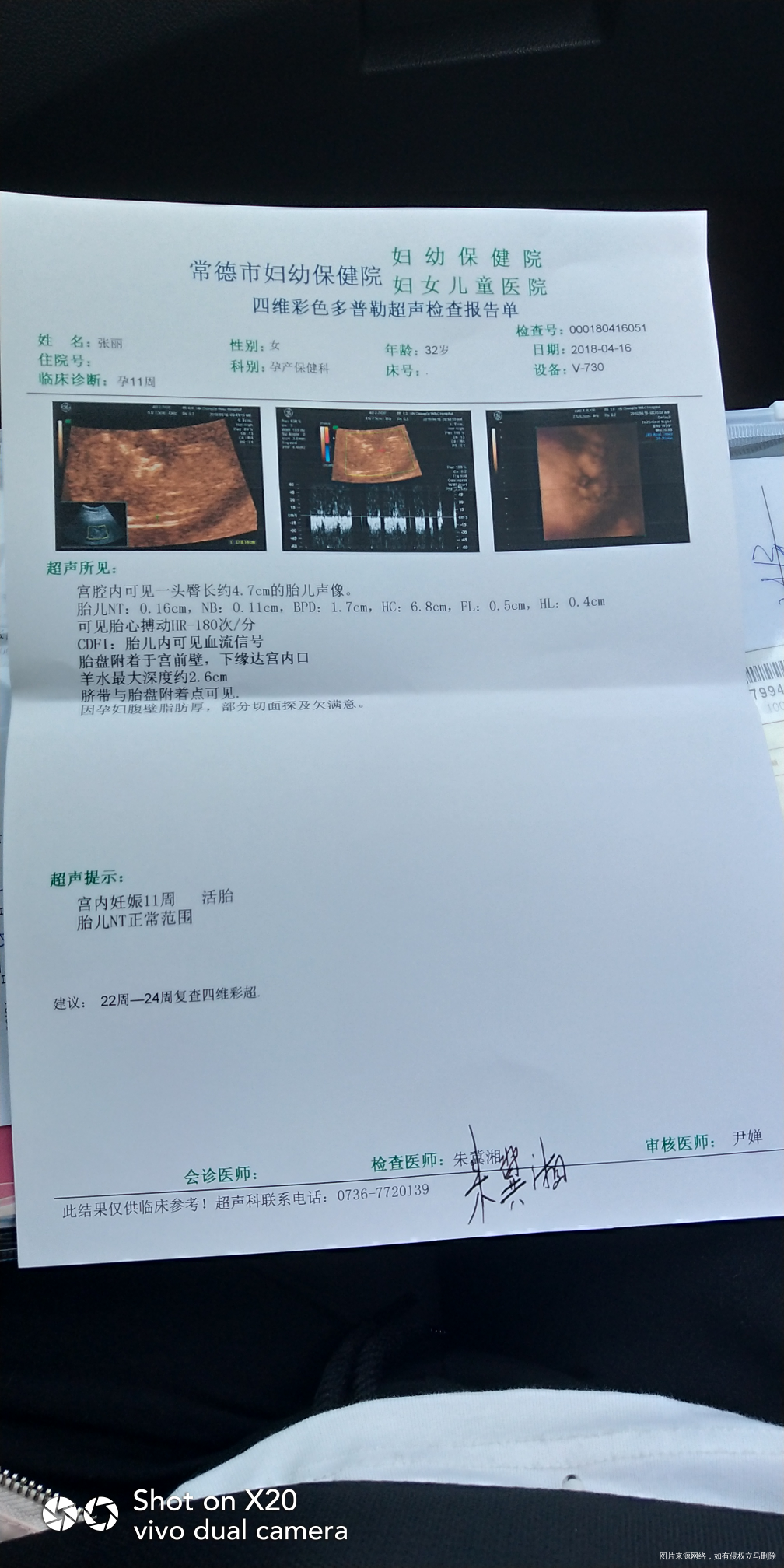 姐妹们帮忙看看今天的NT报告单孕11周