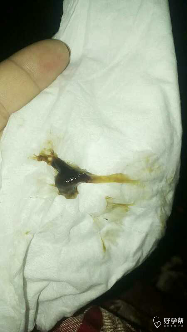 昨晚上上过厕所突然流出来褐色粘稠物
