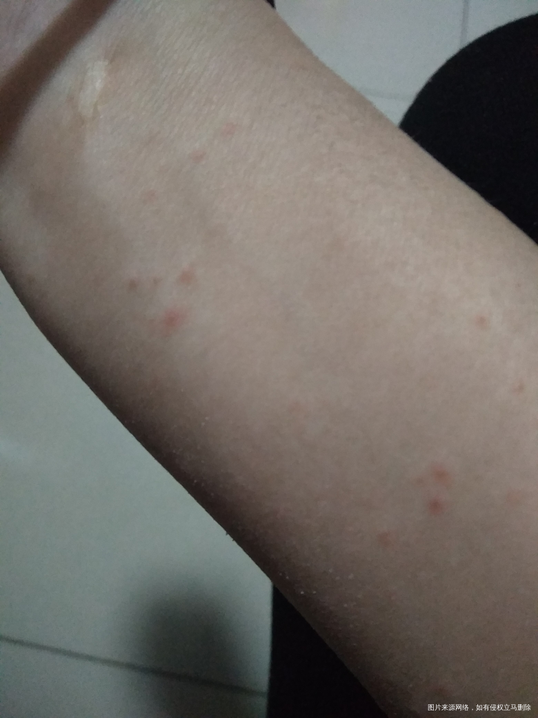 怀孕3个月身上起了很小红点?是什么?痒一挠就破