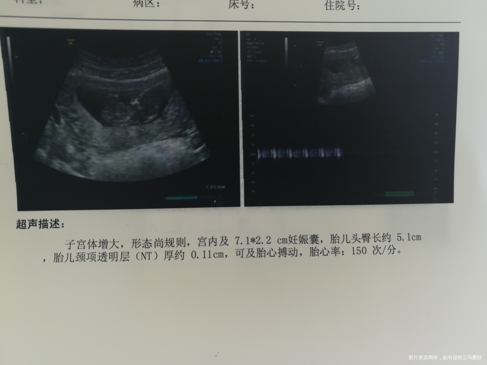 两次b超,胎儿长大了,孕囊变小了怎么回事