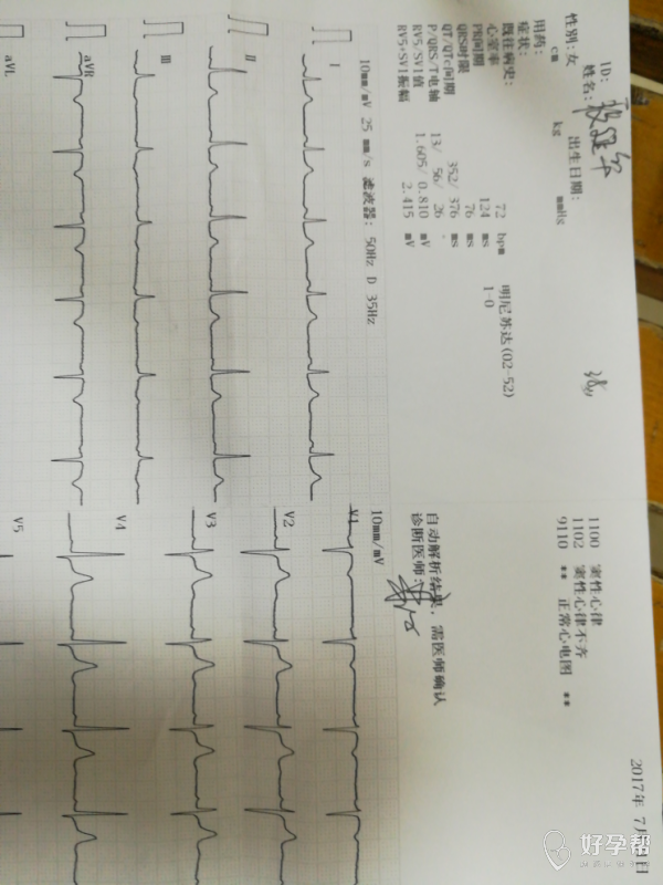 心电图显示窦性心律不齐