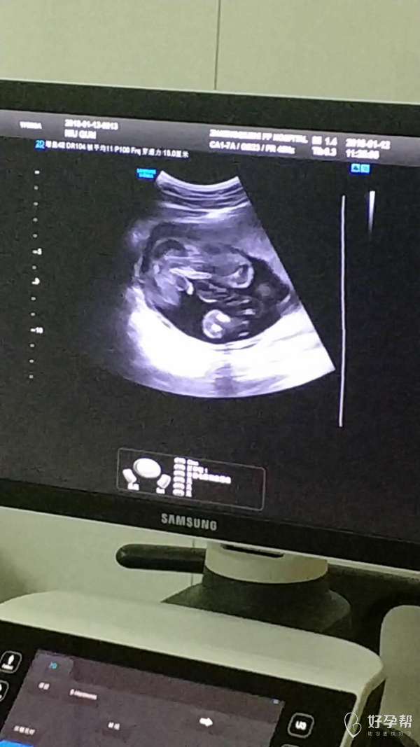 这个视频中的胎儿是男孩吗