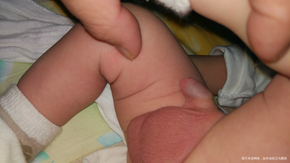 请问大夫孩子阴茎的一半与阴囊长在了一起正常吗