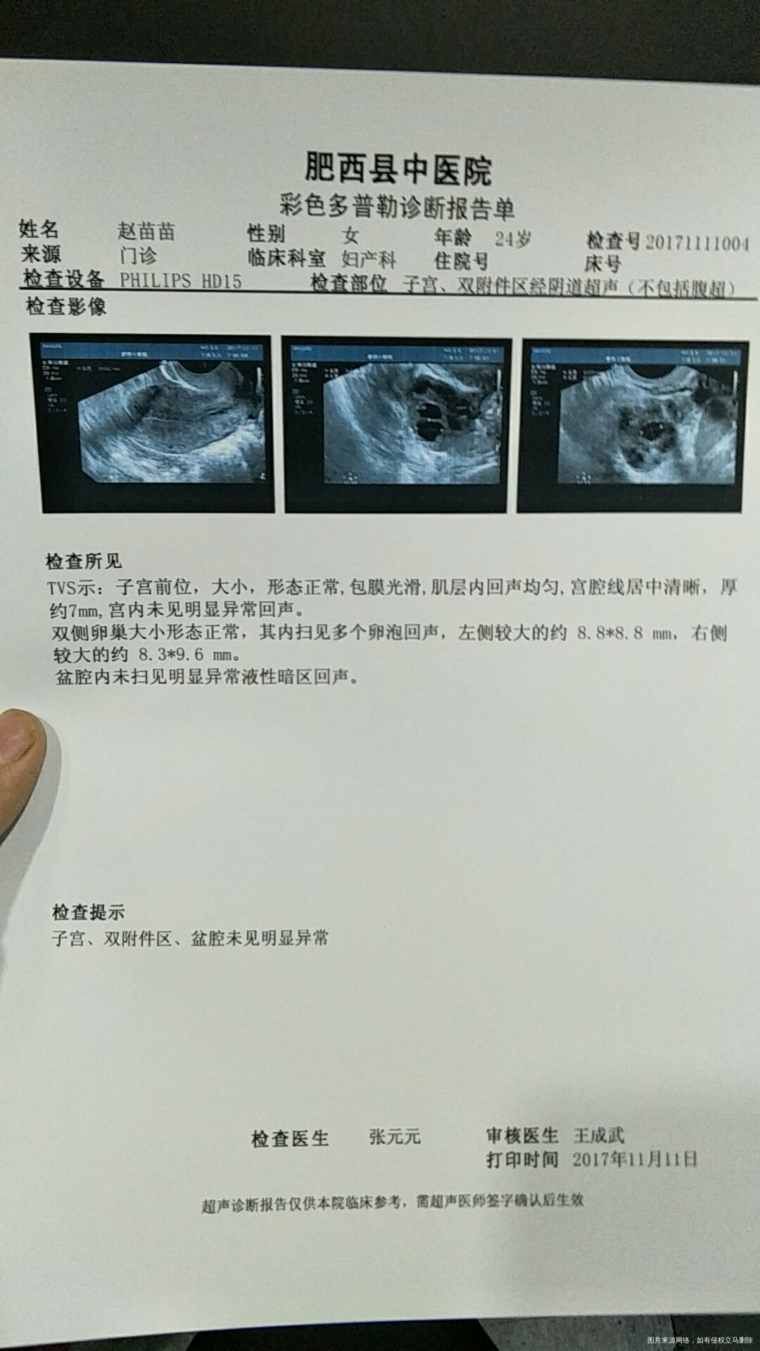 所有的激素都正常,为什么促排卵泡长不大。