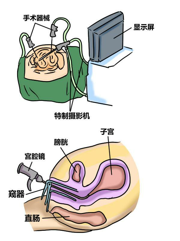 #宫腔镜手术#做过宫腔镜手术的姐妹们一起来聊聊吧