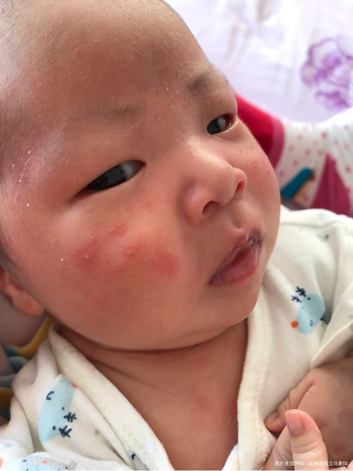 新生儿22天,这是湿疹吗?