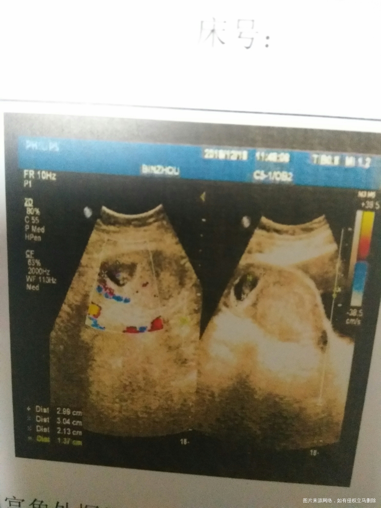 右侧宫角妊娠,想保住孩子,希望大吗?