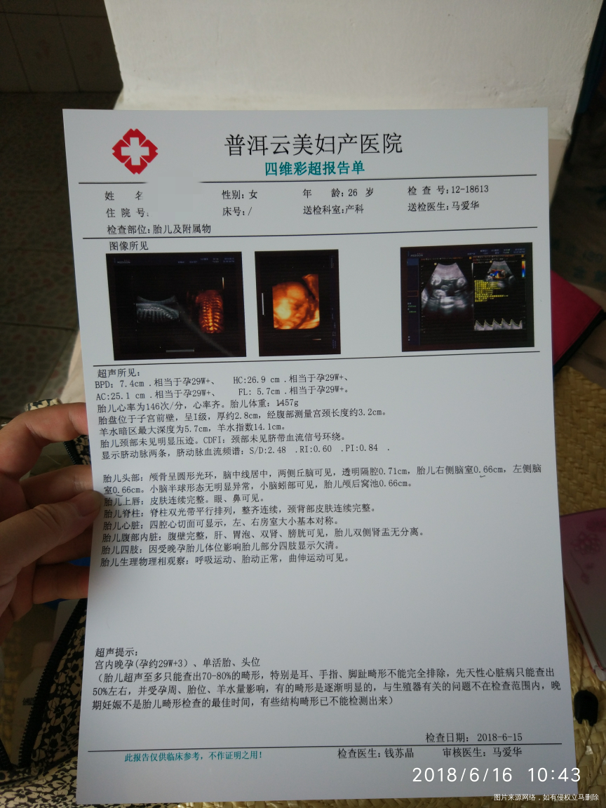 麻烦医生帮忙看一下胎儿有脑积水吗?