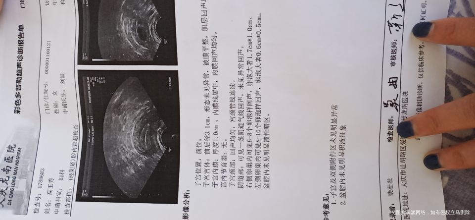 你好,我想问一下试管做排卵检测