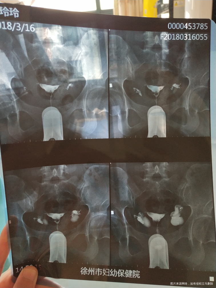 输卵管双侧积水梗堵想要孩子一直没有