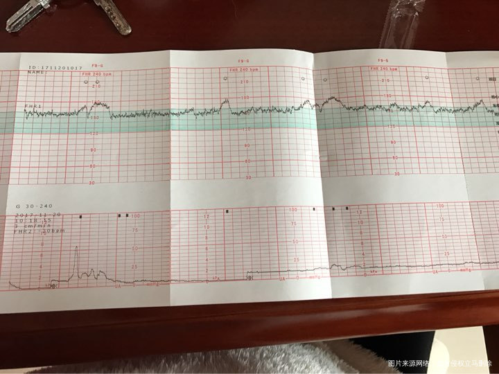 帮看看胎心监护图是否正常