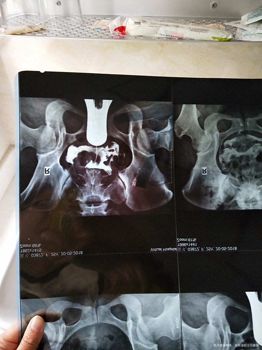 今天去医院做了造影 请帮忙看看