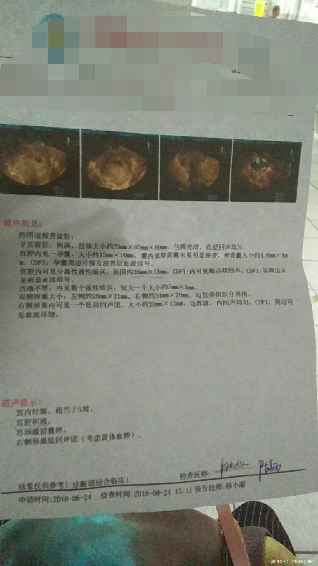 先兆流产情况很严重吗?😭😭该怎么办