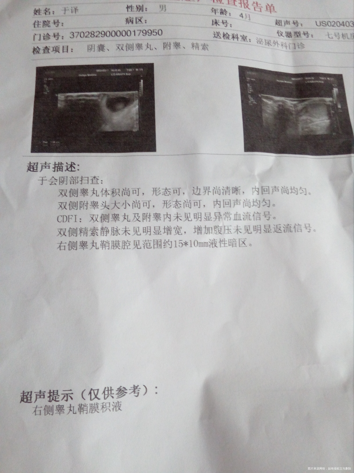 医生宝宝4个月了睾丸积液10*15毫米严重吗