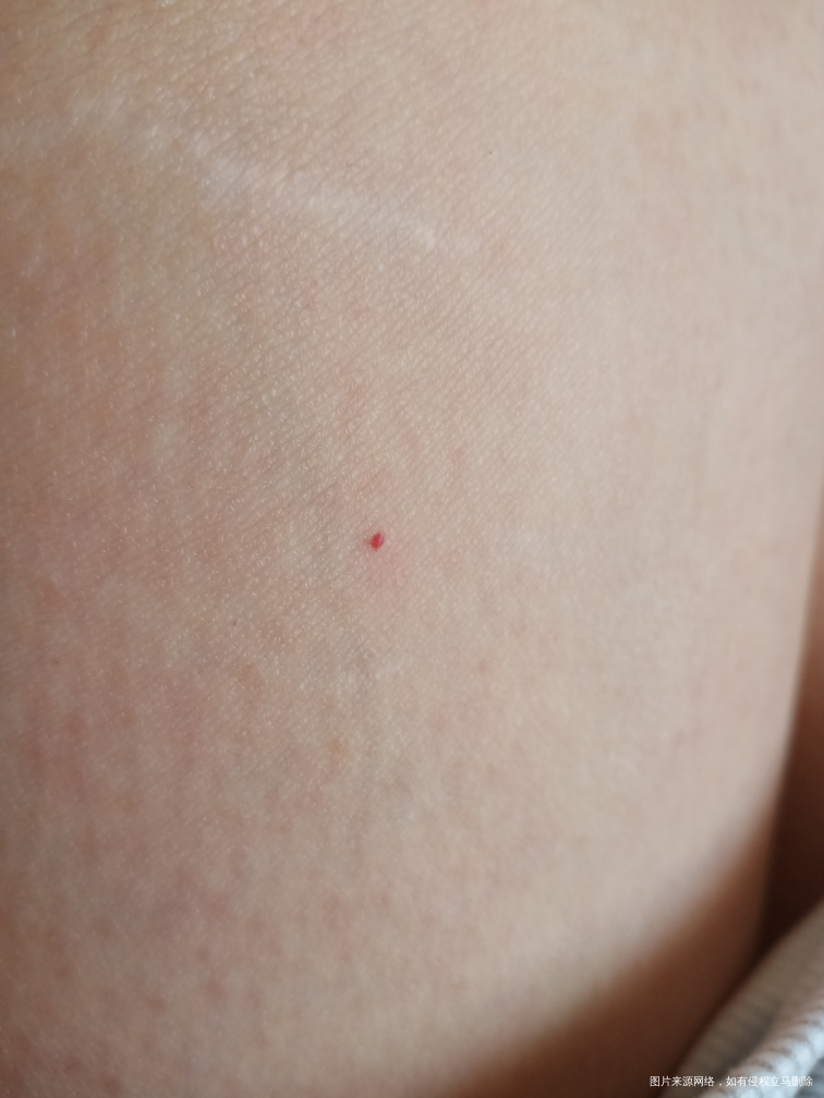 皮肤表层总是会有许多这样的红点,怎么了?