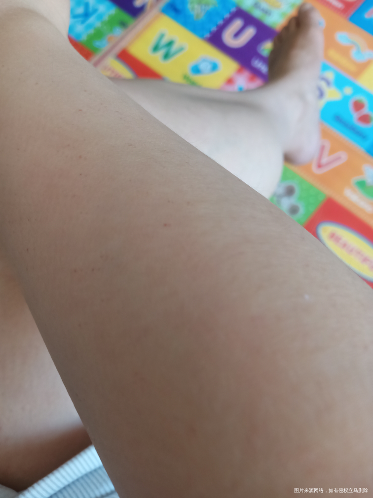 皮肤表层总是会有许多这样的红点,怎么了?