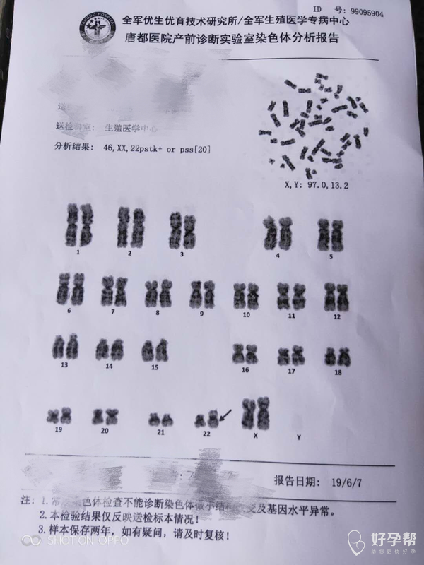 22号染色体查出问题?