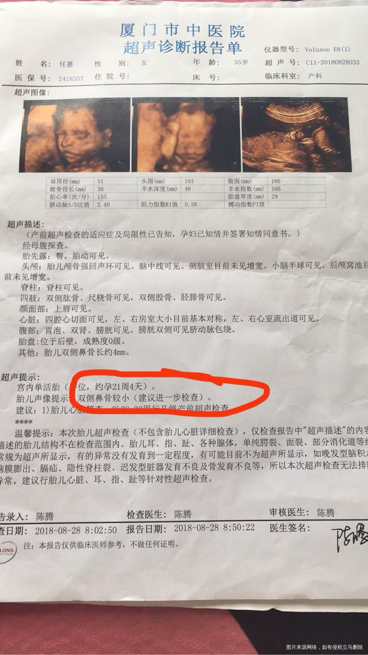 求助医生,鼻骨较小是怎么回事