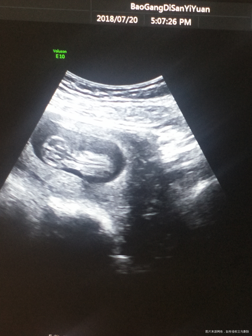 怀孕12周,医生让做NT检查,我们亲亲的大宝就是不配合,不是趴着,就是侧着,正着...