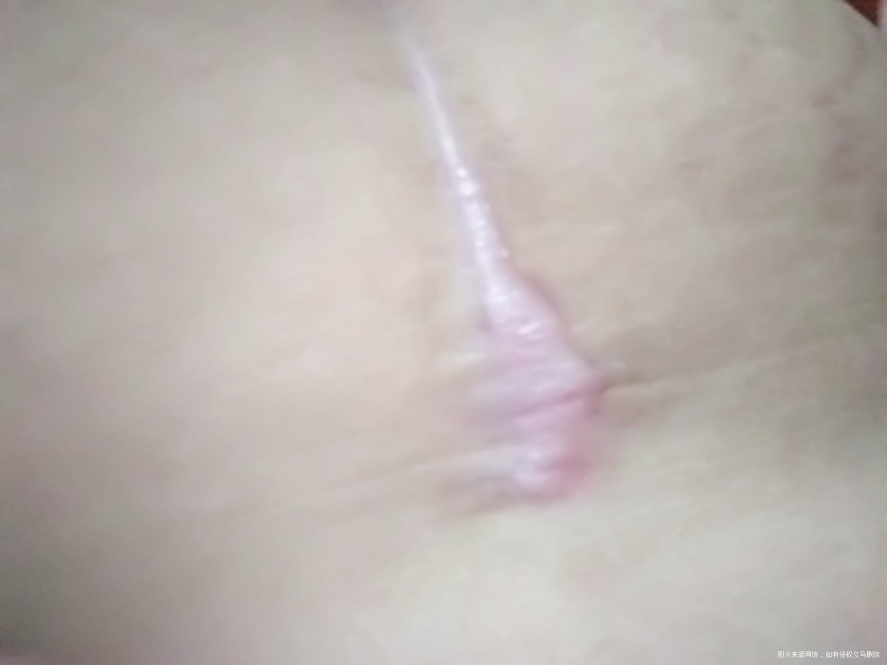 各位医生,帮忙看看,查了百度应该是疤痕增生,想问下这个是吗?