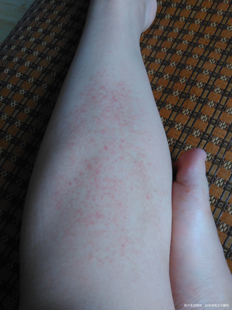 怀孕19周腿上起了红疙瘩。