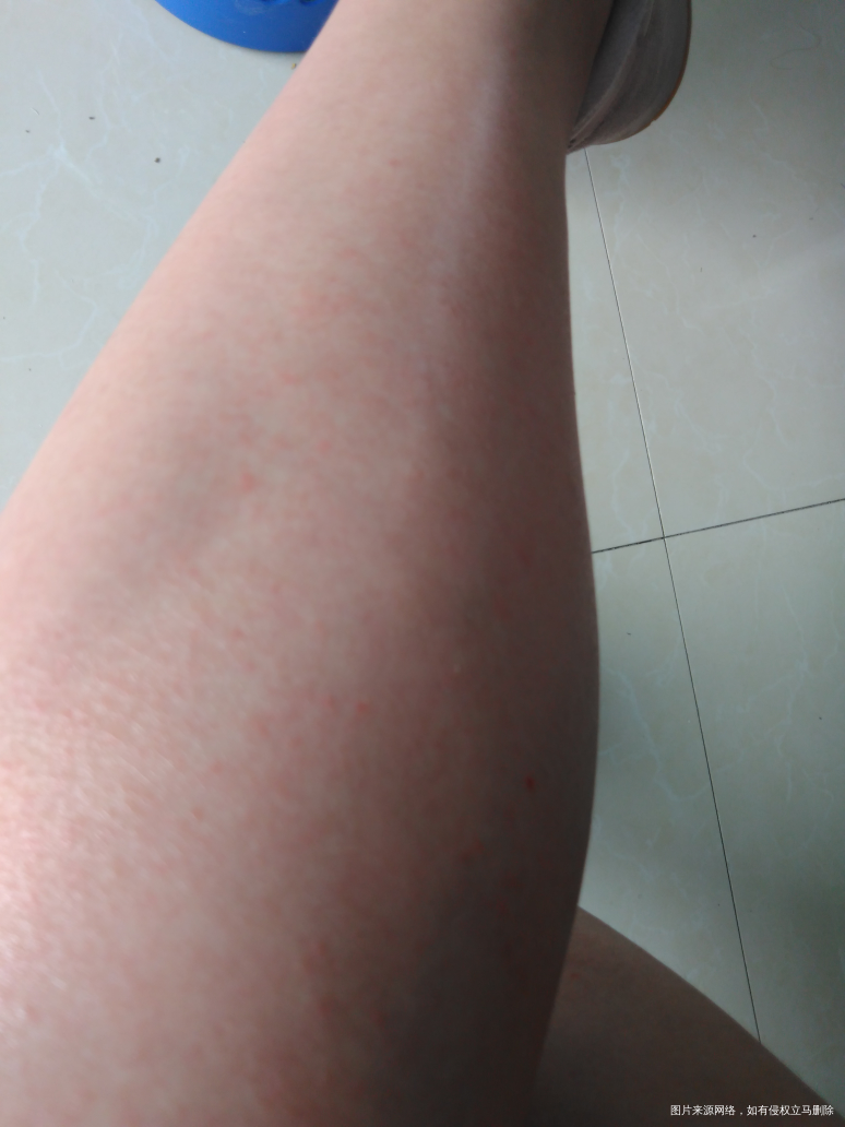 怀孕19周腿上起了红疙瘩。