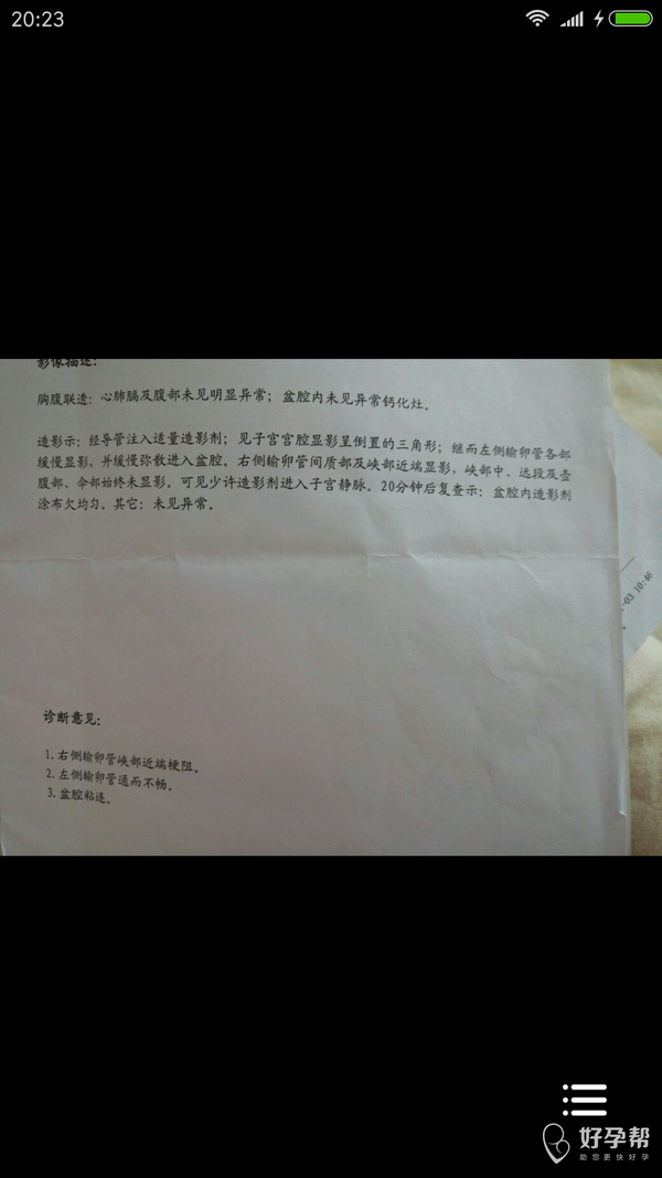 以前输卵管堵塞堵塞,上个月做了输卵管导丝介入手术,当时开了3天奥硝