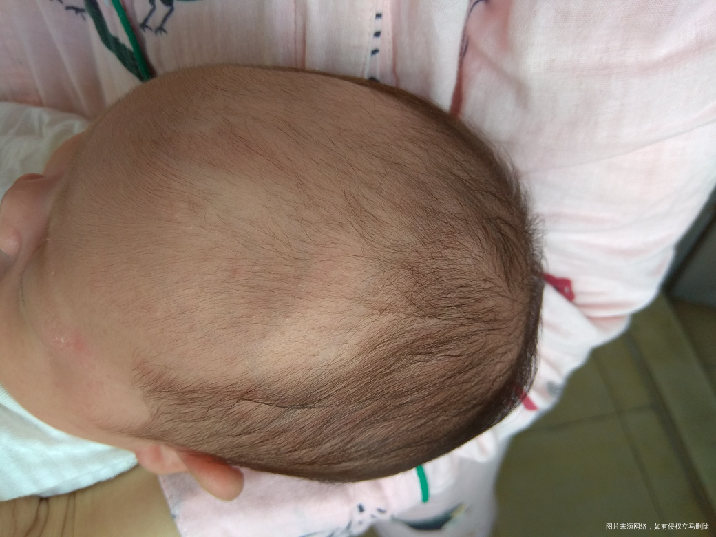 宝宝掉头发和长疹怎么办