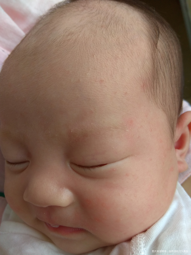 宝宝掉头发和长疹怎么办