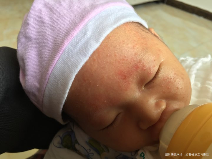 求助,看看这是湿疹吗?正常吗?