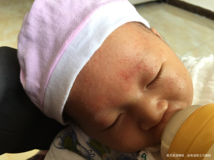 求助,看看这是湿疹吗?正常吗?