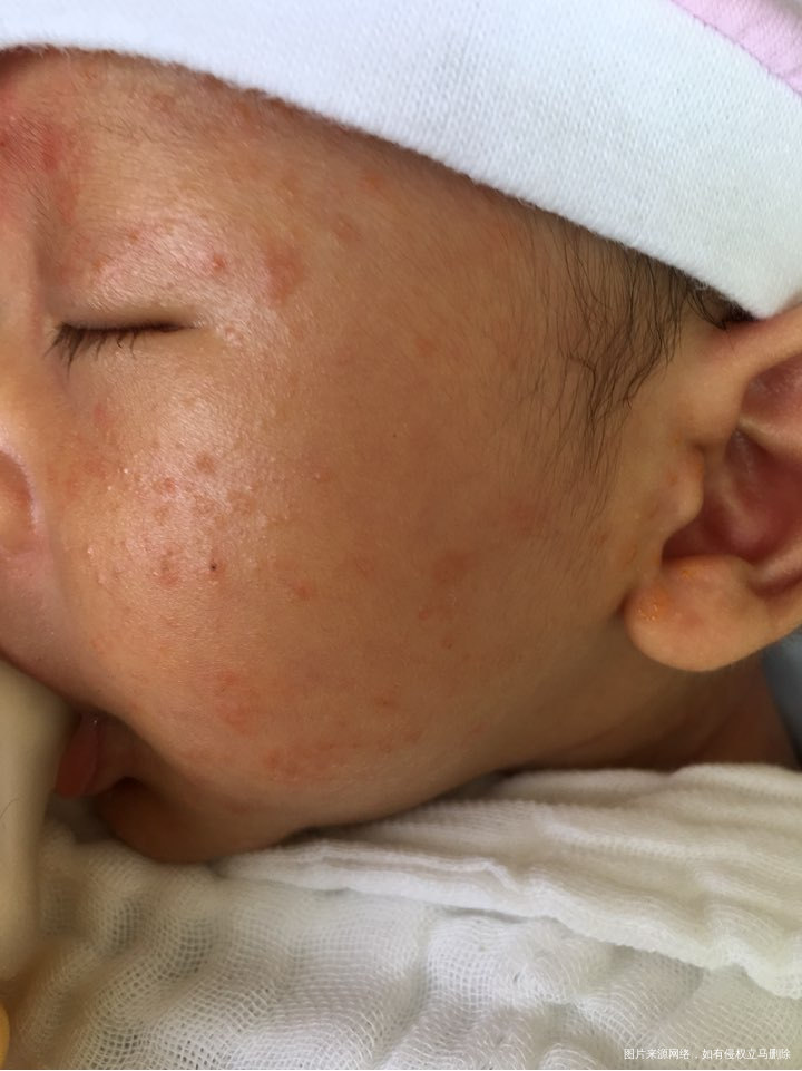 求助,看看这是湿疹吗?正常吗?