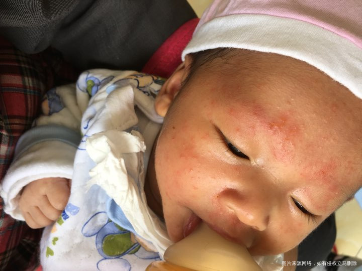 求助,看看这是湿疹吗?正常吗?