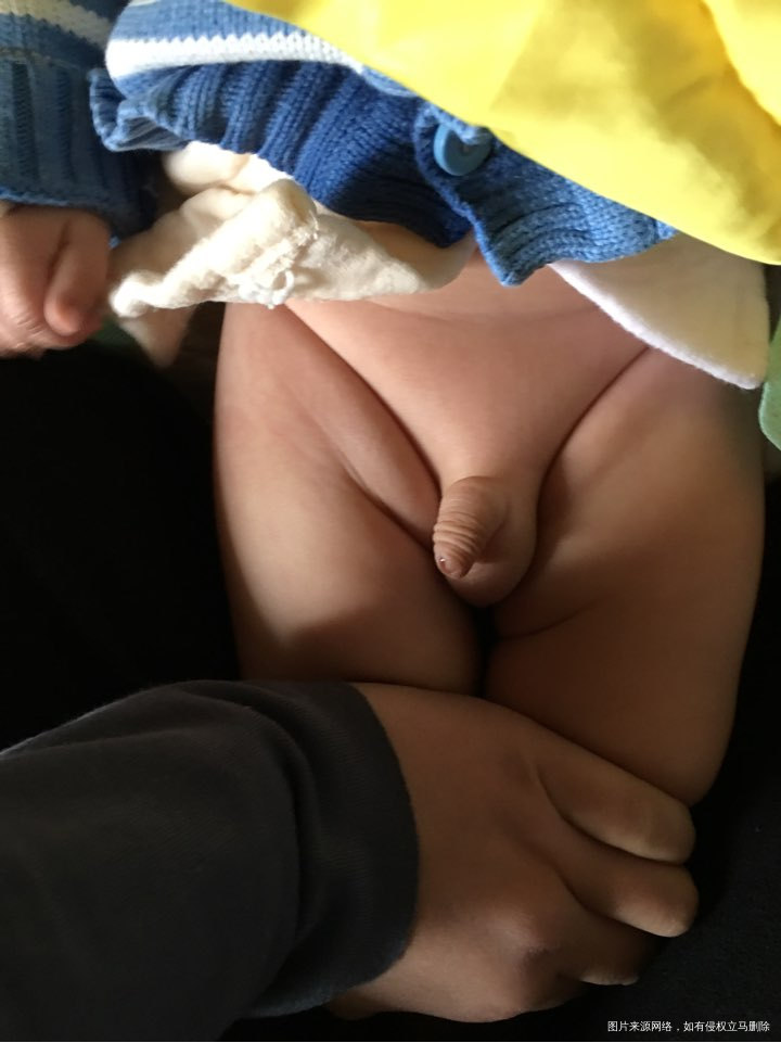 宝宝3个月了，今天去做儿保，医生说腿纹不齐！