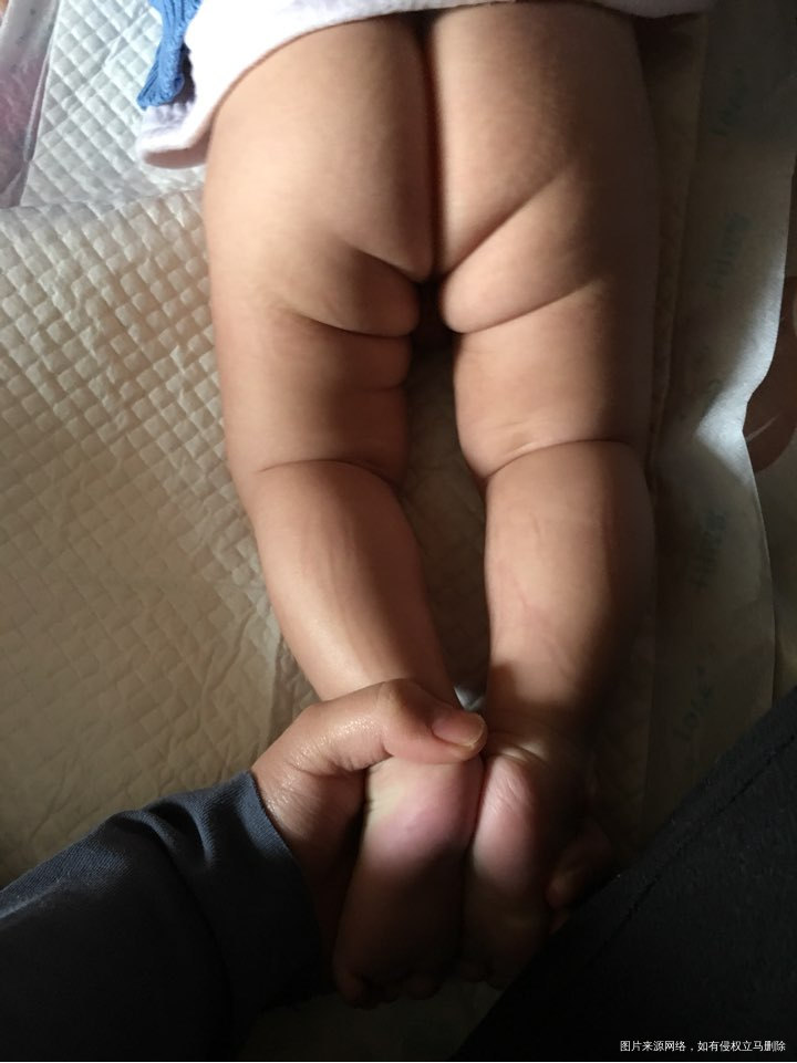 宝宝3个月了，今天去做儿保，医生说腿纹不齐！
