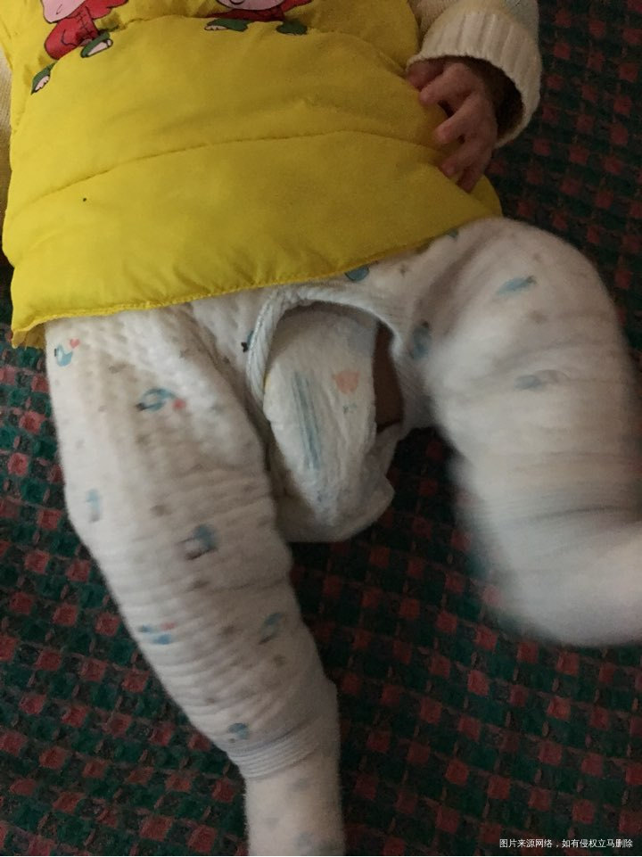 有医生在吗?3个月宝宝臀纹不齐!