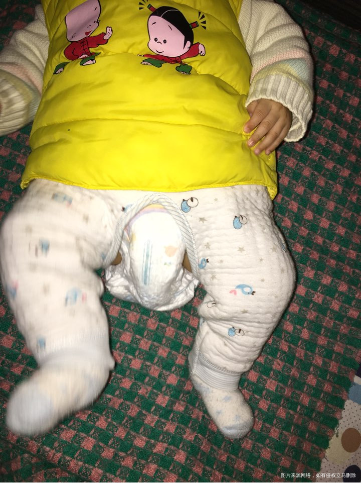 有医生在吗?3个月宝宝臀纹不齐!