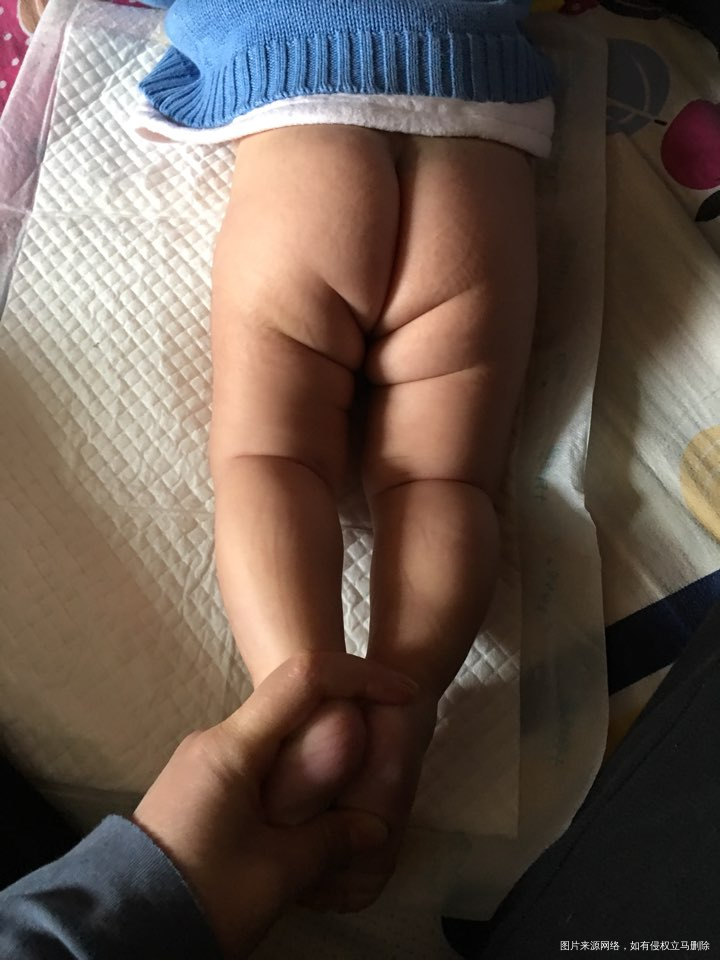 有医生在吗?3个月宝宝臀纹不齐!