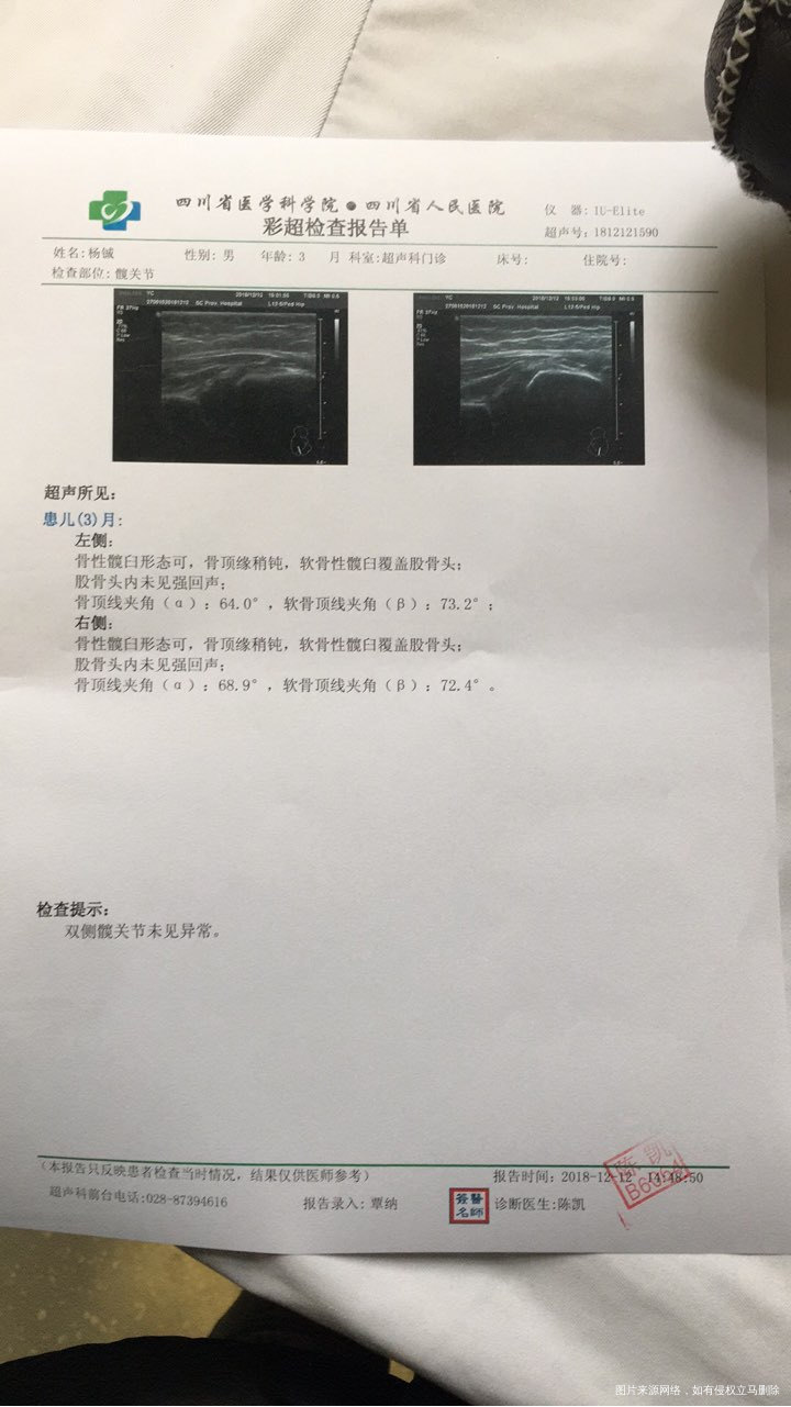 有医生在吗?3个月宝宝臀纹不齐!